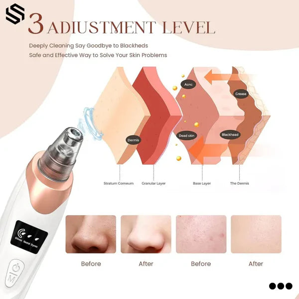 Electric Blackhead Remover | Vacuum Acne & Pore Cleaner | 5 Heads Suction Machine
