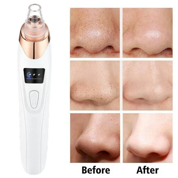 Electric Blackhead Remover | Vacuum Acne & Pore Cleaner | 5 Heads Suction Machine